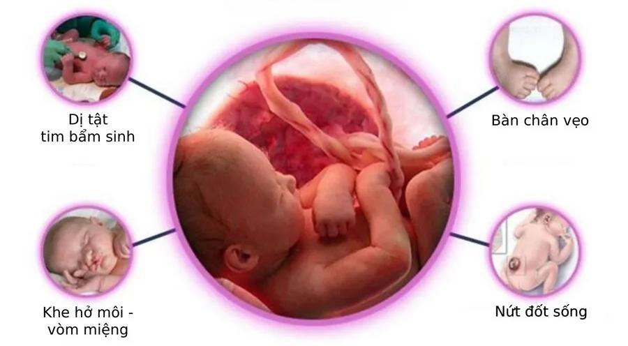 Một số dị tật bẩm sinh phổ biến ở thai nhi