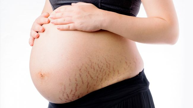Tình trạng rạn da xuất hiện ở mẹ bầu