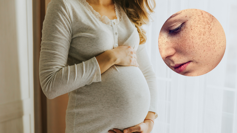 Thay đổi nội tiết khiến da mặt mẹ bầu dễ sạm nám