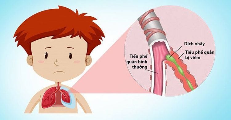 Viêm tiểu phế quản cũng là bệnh trẻ thường gặp khi giao mùa